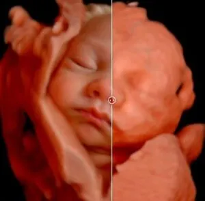 ecografía 5d y realidad